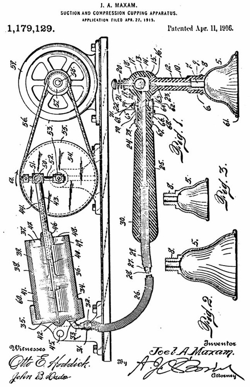 Patent for a complex cupping pump.jpg