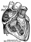 The right auricle and ventricle laid open